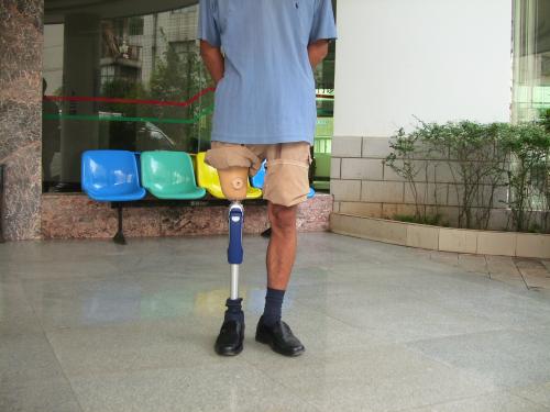 假肢制作流程的詳細(xì)闡述(圖1) 假肢